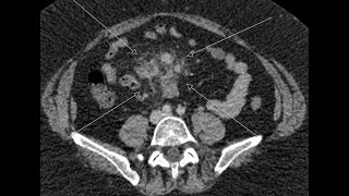 Mesenteric Panniculitis or Sclerosing mesenteritis [upl. by Yokoyama]