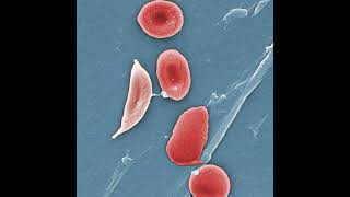 Sickle Cell Disease in the ED [upl. by Nylodnarb579]