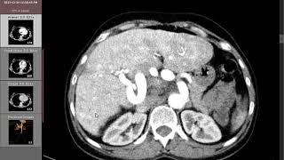 CT Angiography Case16 Hepatic splenic and SMA aneurysms [upl. by Brandon866]