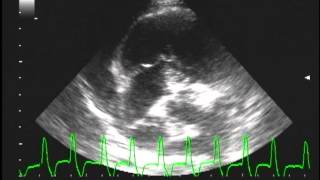 multifocal Ventricular Tachycardia with Right Atrial mass [upl. by Aylmar]