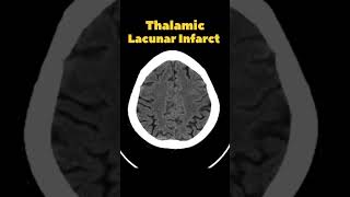 Thalamic Lacunar Infarct  Thalamic stroke  CT Brain 🧠stroke brain ctscan [upl. by Asserrac366]