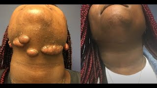 Ashley Noel Kings Keloid Removal [upl. by Swaine]