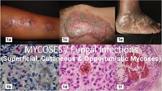 Mycoses  Fungal Infections  Superficial Cutaneous amp Opportunistic Mycoses  Microbiology Lecture [upl. by Suhpoelc]