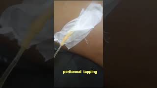 Abdominal tapping  paracentesis  shorts [upl. by Nifares]