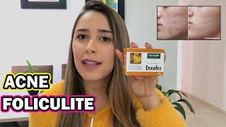 SABONETE DE ENXOFRE FOLICULITE ACNE  ANTES E DEPOIS  Amanda Câmara [upl. by Ahsimit]