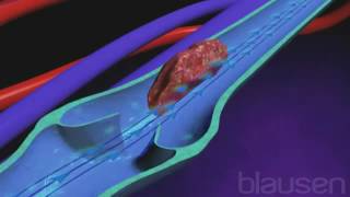 Phlébite symptômes causes et traitement de la thrombose veineuse [upl. by Jann]