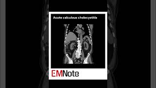 Acute Cholecystitis medical [upl. by Egide245]