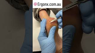 Severely painful cracked bleeding heel fissure treatemnt in podiatry clinic [upl. by Lizbeth148]