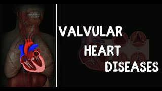 Valvular Heart Disease [upl. by Isolt]