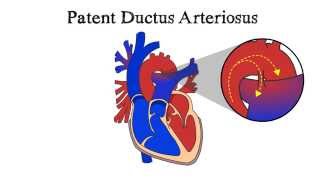 Patent Ductus Arteriosus PDA [upl. by Tuneberg]