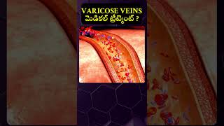 Varicose veins  Simple medical treatment varicoseveinstreatment shorts [upl. by Adnof]