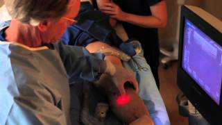 EVLT Endovenous Laser Treatment [upl. by Ppik]