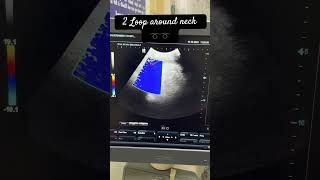 2 Loop around neck on usg  obstetrics fullterm sonography neetpg beautiful music [upl. by Susejedesoj]