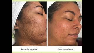 Dermaplaning Facial  VS MedSpa Laser Clinic [upl. by Pieter]