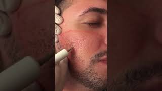 Tratamento de cicatrizes de acne com jato de plasma [upl. by Ainosal]