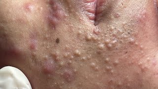 ACNE UNDER SKIN P2  Acne Treatment Mai Ngoc Da Nang [upl. by Waldemar]