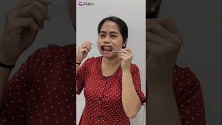 My Double Jaw Surgery Journey 5 Days PostOp Update for Gummy Smile Correction [upl. by Bonns549]