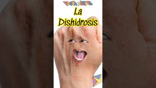 La Dishidrosis 😱 Explicado shortvideo [upl. by Kcarb]