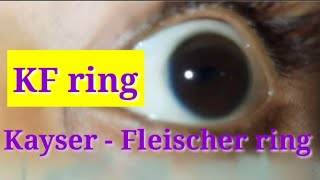 Kayser  Fleischer ring  Wilsons disease [upl. by Jeannie363]