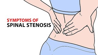 Symptoms of Spinal Stenosis [upl. by Azalea]