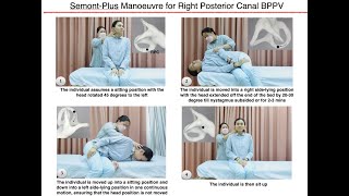 SemontPlus Manoeuvre for Right Posterior Canal BPPV [upl. by Backer]