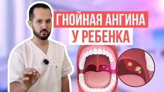 Гнойная ангина у ребенка  что делать [upl. by Alrac]