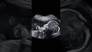 Baby movement in womb pregnancytips pregnant pregnancy ultrasound [upl. by Pirri]