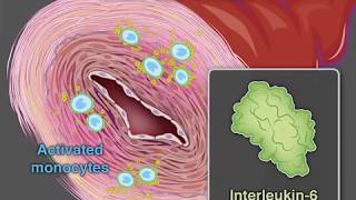 Treating GiantCell Arteritis [upl. by Waldon]