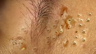 Big Cystic Acne Blackheads Extraction Blackheads amp Milia Whiteheads Removal Pimple Popping  8359 [upl. by Yeca]