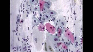 Cervix Low grade squamous intraepithelial lesion LSIL Pap smear [upl. by Florine]