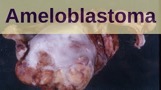 Ameloblastoma  Pathology mini tutorials [upl. by Armahs]