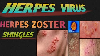 Best Ayurvedic Medicine For Herpes  हार्पीज़ नी देसी दबा  Genital Herpes  Herpes Zoster [upl. by Eiddal745]