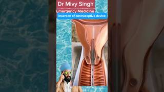 Inserting Contraceptive Device contraception contraceptives uterus [upl. by Tloh]