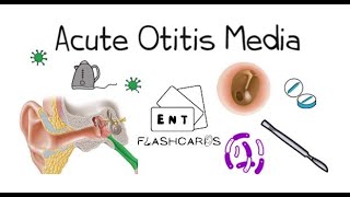 Acute Otitis Media  FRCS ENT Exam Essentials [upl. by Ham]