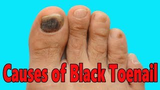 CAUSES OF BLACK TOENAIL HOW TO GET RID OF A BLACK TOENAIL CURE OF BLACK TOENAIL FOOTLOOSE [upl. by Eadrahs]