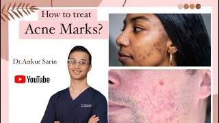 Acne Marks treatment  Acne treatment Dermatologist  Lasers and peels  Dr Ankur [upl. by Evars281]