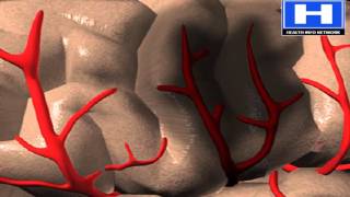 Embolism vs Thrombus symptoms causes pathophysiology and treatment [upl. by Armelda]