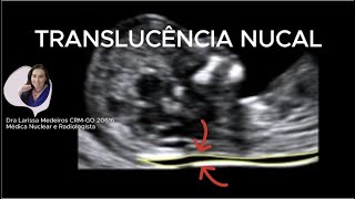 TRANSLUCÊNCIA NUCAL  Ultrassom obstétrico [upl. by Eneirda]