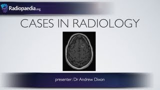 Cases in Radiology Episode 1 neuroradiology CT MRI [upl. by Enilasor183]