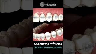 BRACKETS ESTÉTICOS [upl. by Peppie]