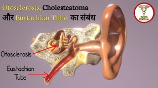 nasal decongestant spray  eustachian tube dysfunction [upl. by Seiuqram]