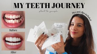 MY TEETH JOURNEY  Invisalign Composite Bonding Whitening  Answering All Your Questions [upl. by Amero]