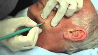 How to remove facial warts using Cautery [upl. by Trotter30]