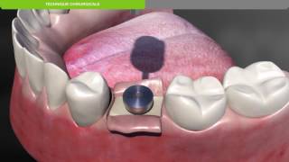 Biotech Dental Protocole chirurgical de pose dun implant dentaire KONTACT souscrestal [upl. by Paul]