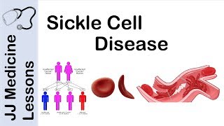 Sickle Cell Disease  Pathophysiology Symptoms and Treatment [upl. by Ryhpez]