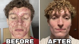 MY 8 MONTH ACCUTANE JOURNEY [upl. by Romelle]