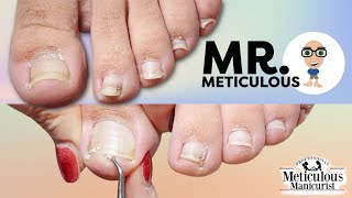 Impacted Toenail PEDICURE Cleaning on Mr Meticulous [upl. by Rutledge483]