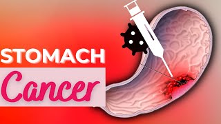 Stomach Cancer Causes Signs and Symptoms Diagnosis and Treatment [upl. by Gibert268]