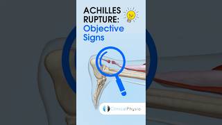 Objective Signs of Achilles Rupture physicaltherapy physiotherapy achilles achillestendon [upl. by Zacharias]