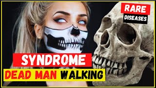 Cotards syndromesyndrome dead walking what is symptoms causes and treatment  Most rare disease [upl. by Timmons941]